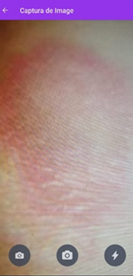 SkinReader for Leprosy